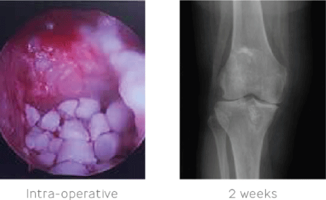 Infected Knee Joint - Biocomposites